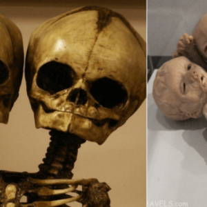 A Rare Glimpse: The Conjoined Twins Skeleton at the Mütter Museum.