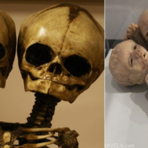 A Rare Glimpse: The Conjoined Twins Skeleton At The Mütter Museum.