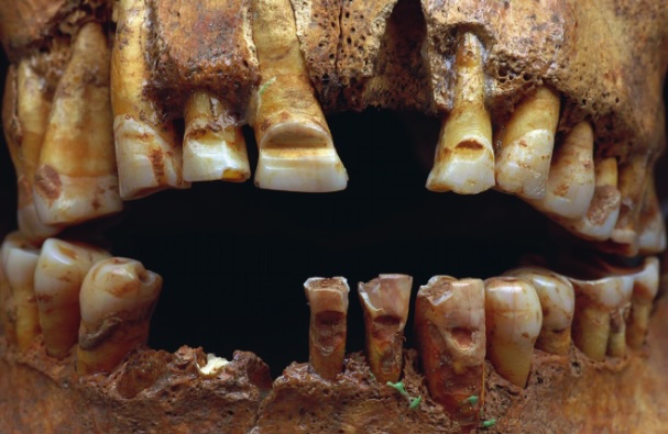 Picture of a Viking's teeth filled with horizontal grooves