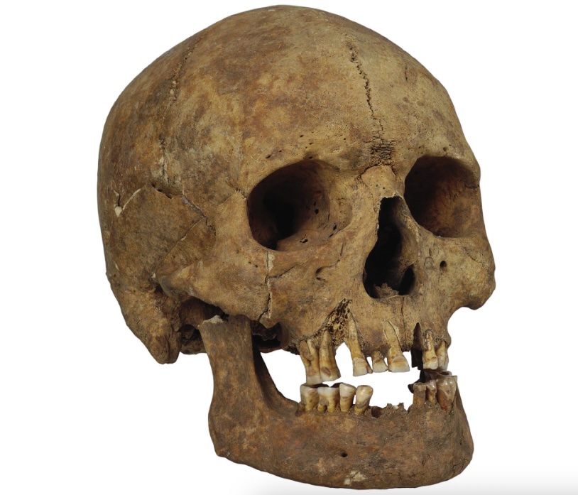 A skull of a man with filed teeth and a healed fracture from Viking Age Gotland