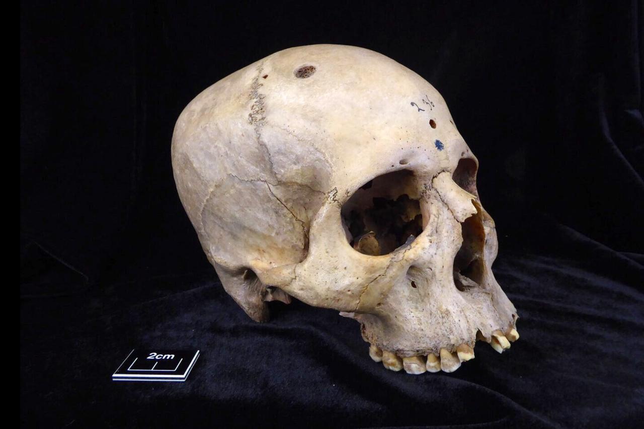 A team of researchers examined two human skulls from the University of Cambridge's Duckworth Collection in the UK. The male skull (pictured here) dates back to between 2687 and 2345 BC.