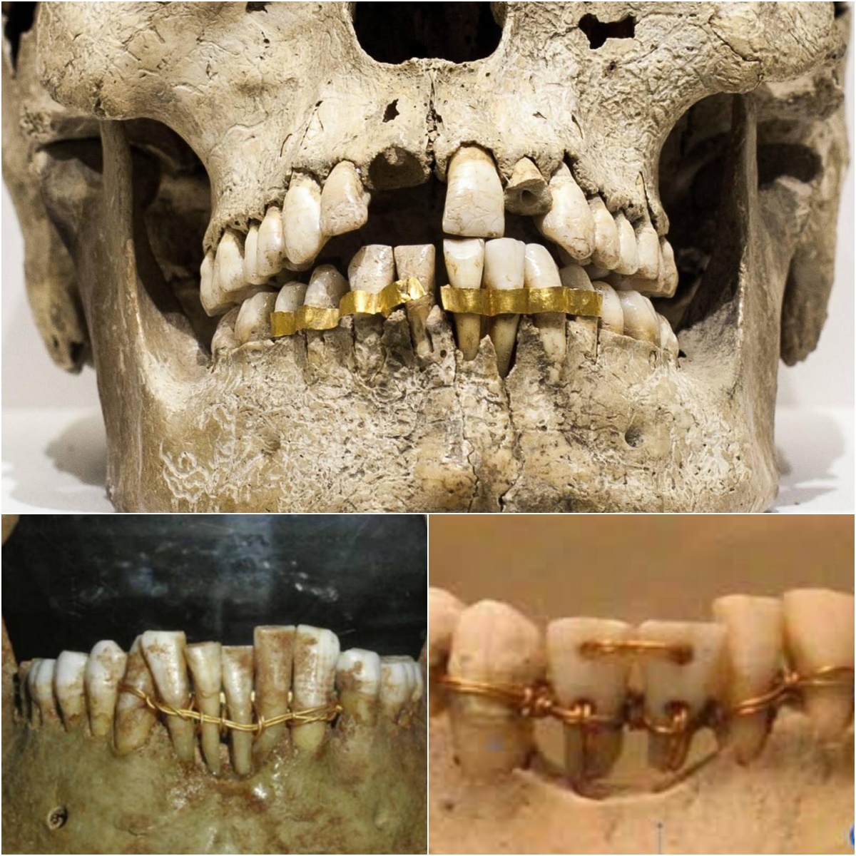 The use of gold wire and plates in ancient Egyptian dentistry