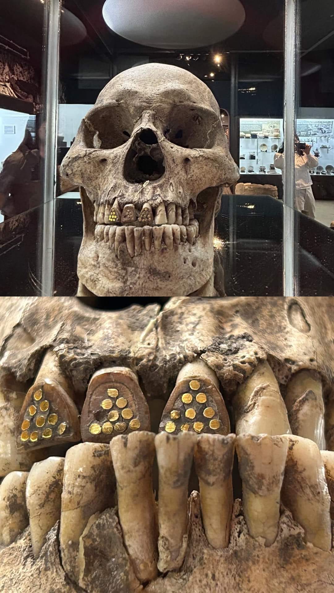 Uncovering Ancient Dental Implants: Insights from the San Carlos University Museum Cebu