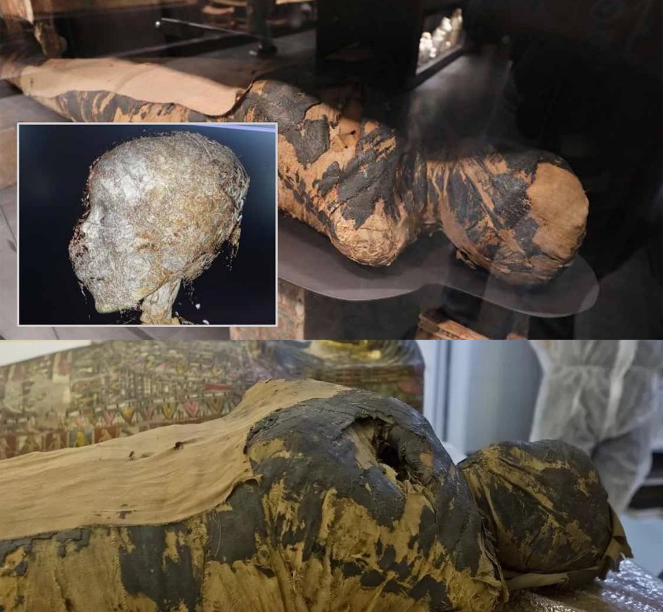 Ancient Egyptian Mummy Reveals Evidence of Nasopharyngeal Cancer, Advancing Modern Medicine