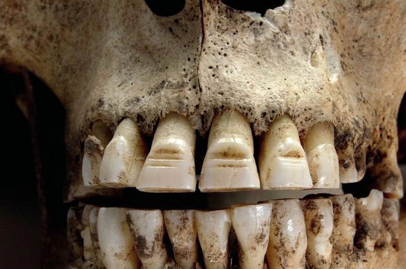 Viking Skull with Filed Teeth Found in Dorset Mᴀss Grave: A Mysterious Symbol of Status or Fear