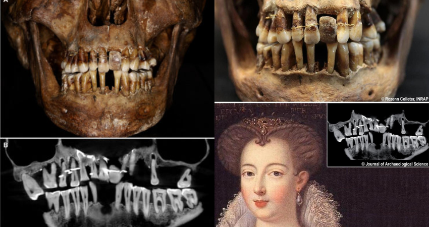 This 17th-Century Aristocrat Had a Crafty Secret For Keeping Her Teeth